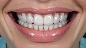 Transform Your Smile with Veneers in Jacksonville: A Guide to Cosmetic Dentistry